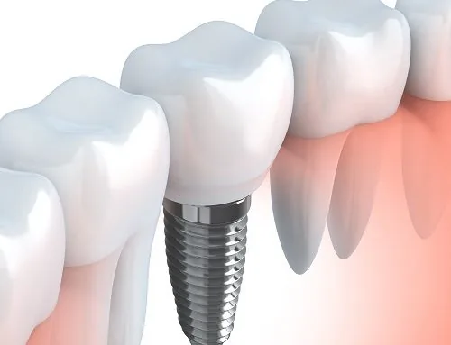 Guidance instructions for implants