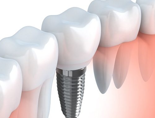 Guidance instructions for implants